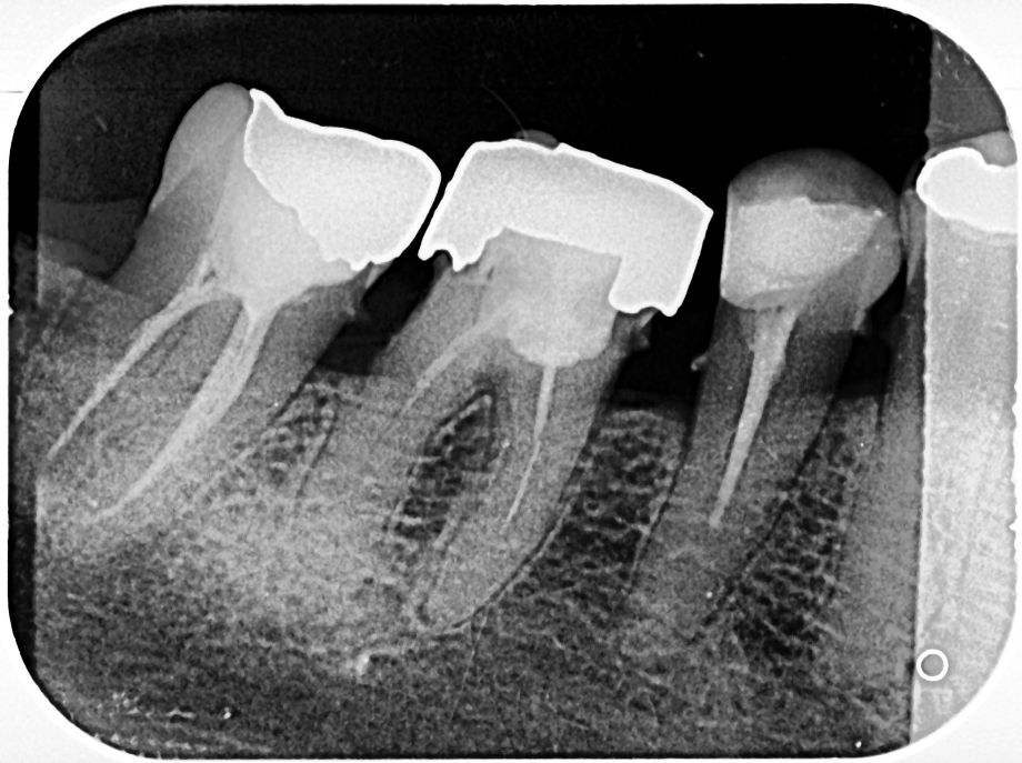 Radiografía Periapical